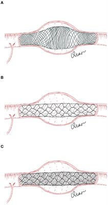 LVIS-within-enterprise double-stent technique with coil embolization in the treatment of patients with acutely ruptured intracranial vertebrobasilar artery-dissecting aneurysms